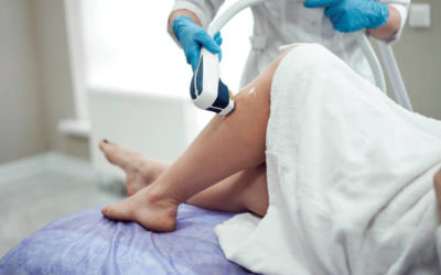 Épilation laser Villefranche : L’épilation au laser est-elle efficace pour prévenir le kyste pilonidal ?