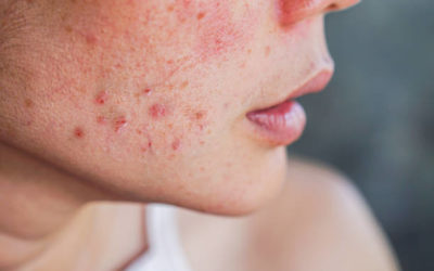 L’impact psychologique des cicatrices d’acné : une blessure invisible