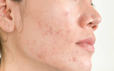 Comment reconnaître une cicatrice d’acné ?