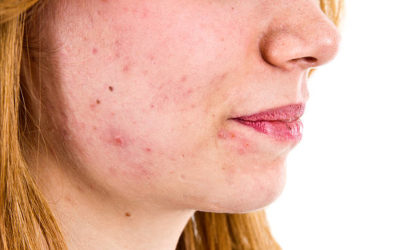 Traitements des Cicatrices d’Acné : Réduisez les marques de votre peau