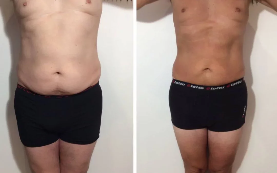Peut-on Combiner la Cryolipolyse avec d’Autres Traitements de Réduction de Graisse?