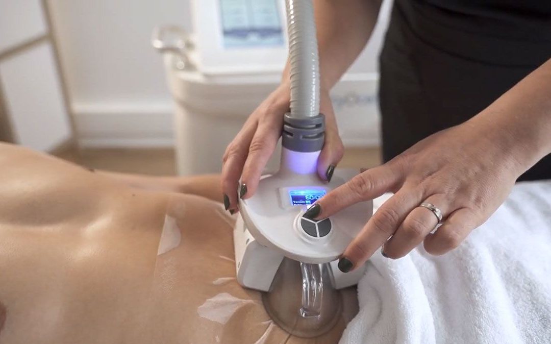 Comparaison entre la Cryolipolyse Ville Franche et la Technologie RF pour la Réduction de Graisse