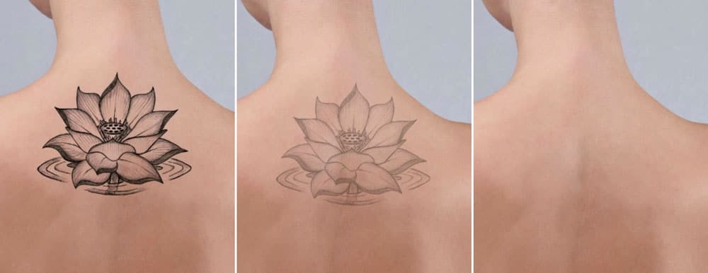Le détatouage laser Villefranche est-il recommandé pour les tatouages récents ?
