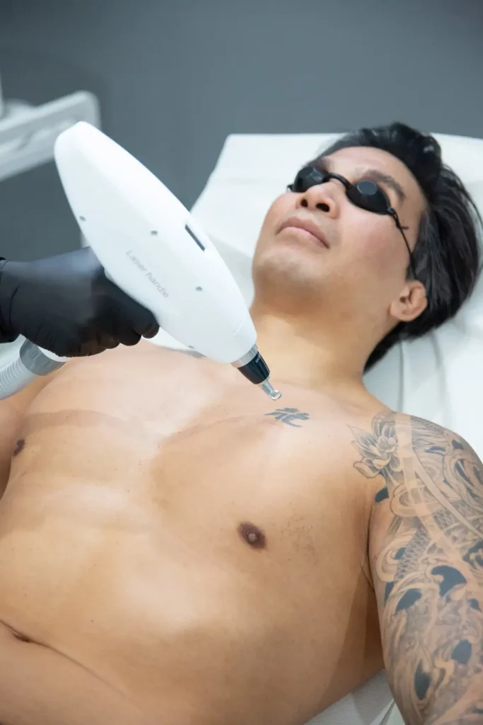 Détatouage laser à Villefranche