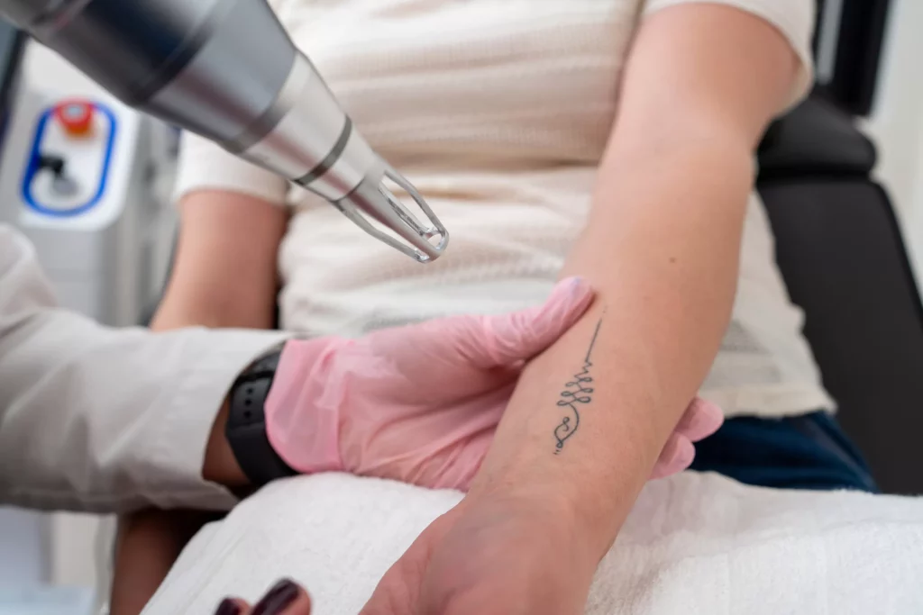 Détatouage laser à Villefranche