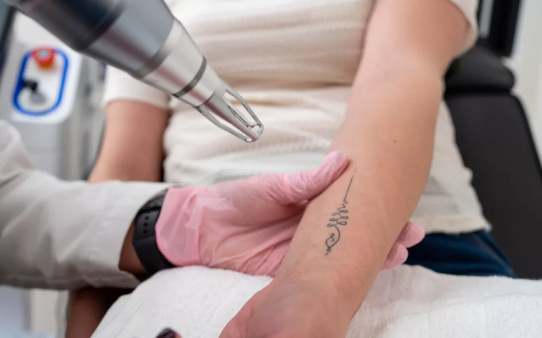 Peut-on traiter les tatouages à l’encre noire avec le détatouage laser à Villefranche ?