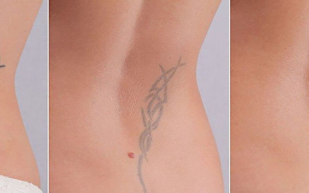 Comment le détatouage laser Villefranche traite-t-il les petites versus grandes zones tatouées ?