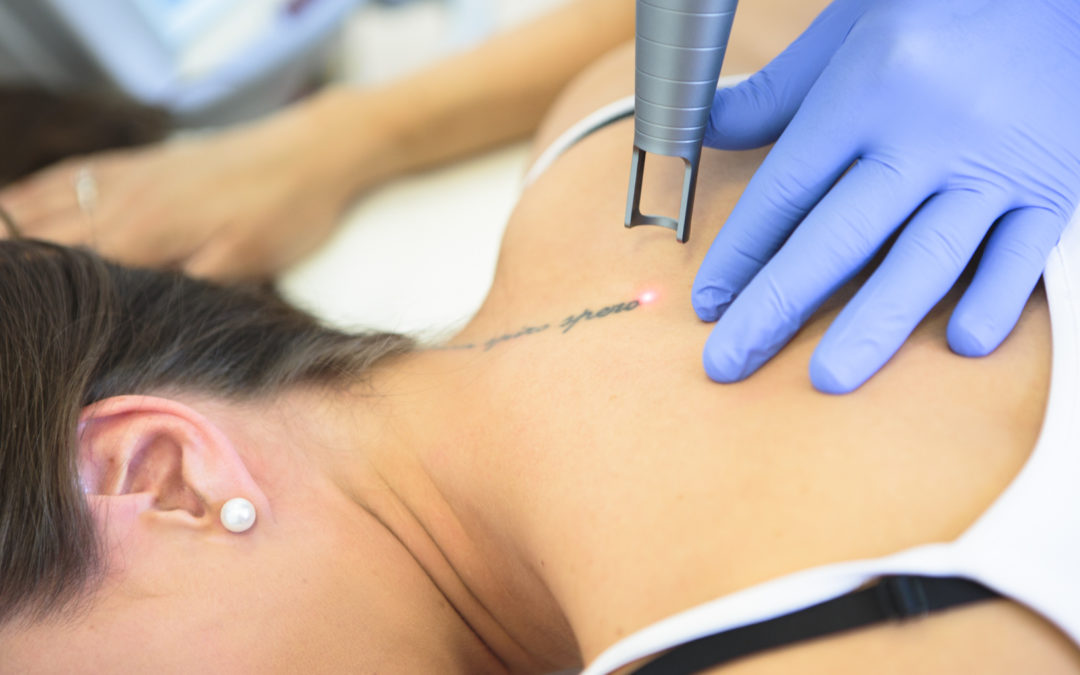 Le détatouage laser Villefranche utilise-t-il des anesthésiques locaux ?