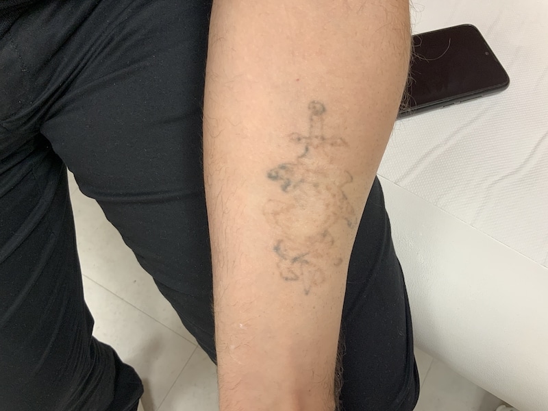 Détatouage laser à Villefranche