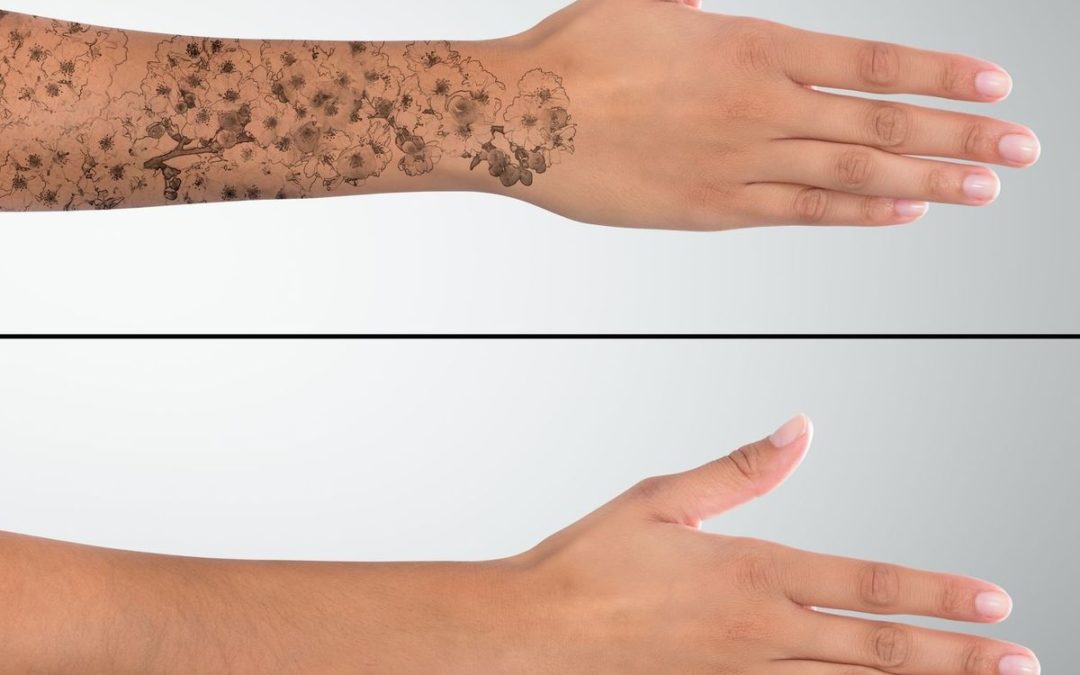 Quels sont les avantages du détatouage laser à Villefranche ?