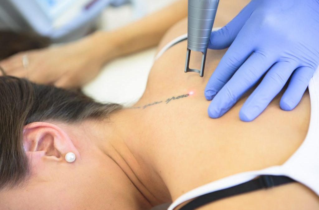 Le détatouage laser à Villefranche est-il douloureux ?