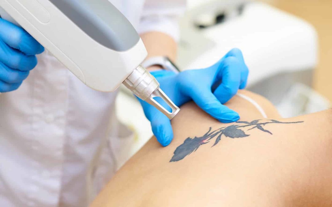 Quels sont les pigments les plus faciles à enlever par détatouage laser à Villefranche ?