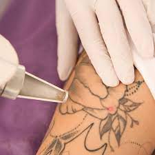 Comment minimiser les risques de cicatrices après un détatouage laser à Villefranche ?