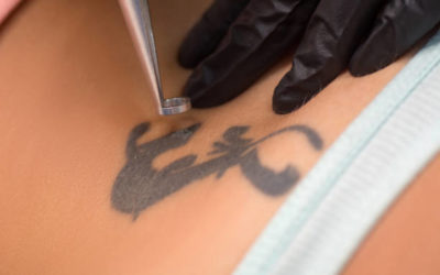 Un dermatologue peut-il prescrire un détatouage laser à Villefranche pour cause médicale ?