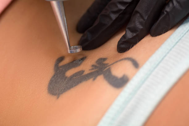 Un dermatologue peut-il prescrire un détatouage laser à Villefranche pour cause médicale ?