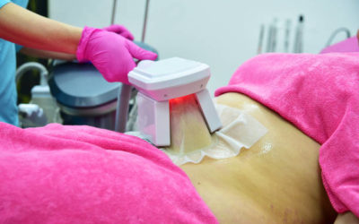 Faut-il suivre un régime particulier après une cryolipolyse à Villefranche ?