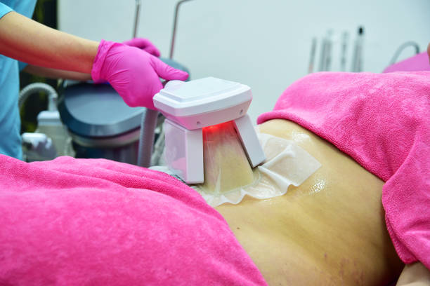 Faut-il suivre un régime particulier après une cryolipolyse à Villefranche ?