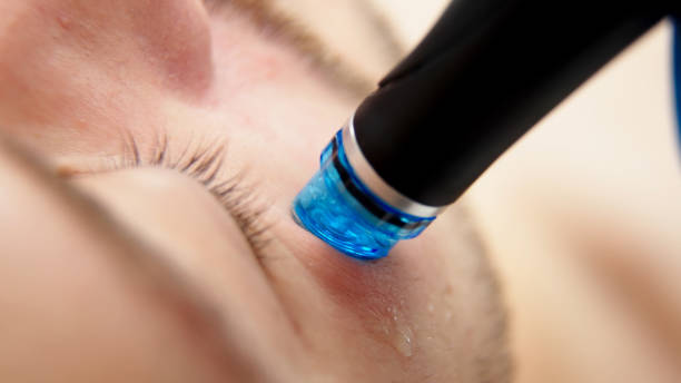 Comment choisir un bon praticien pour un hydrafacial à Lyon en toute sécurité ?